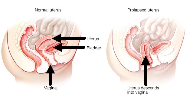 Pregnant Prolapse