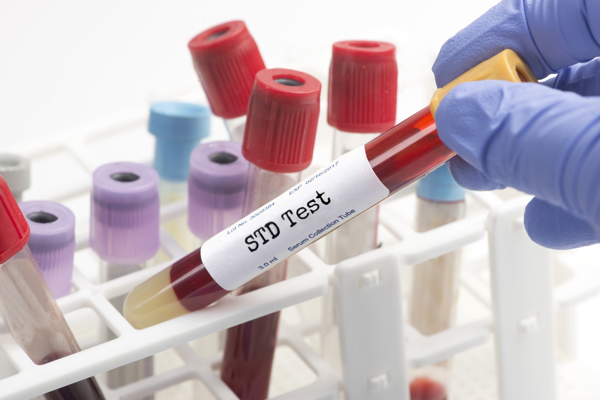 STD Testing blood analysis