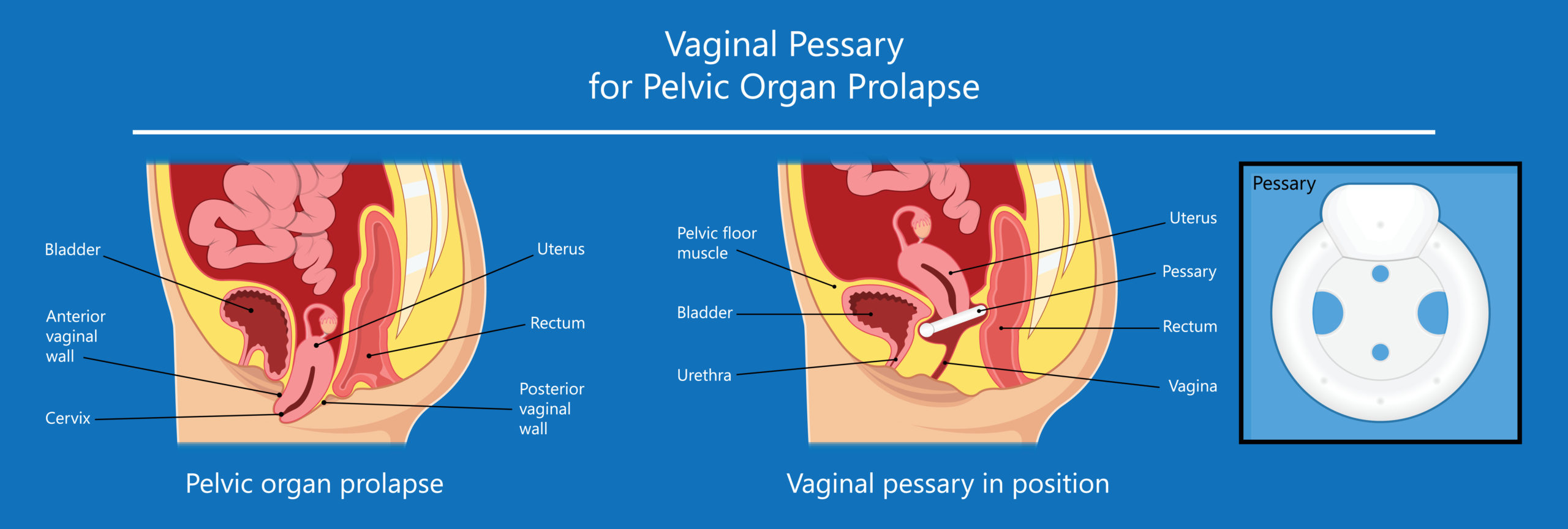 Pessaries: A Non-Surgical Treatment Option for Pelvic Organ Prolapse